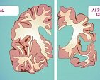 Этапы болезни Альцгеймера